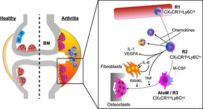 Pathological Osteoclasts and Precursor Macrophages in Inflammatory Arthritis